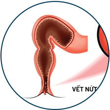 Các nguy hại của bệnh trĩ