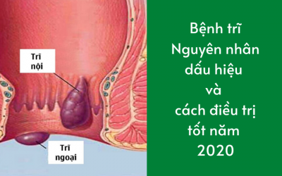 [Lời khuyên] – Bệnh Trĩ : Nguyên Nhân, Triệu Chứng Và Cách Điều Trị