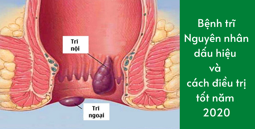 Bệnh trĩ : Nguyên nhân dấu hiệu và cách điều trị tốt năm 2020