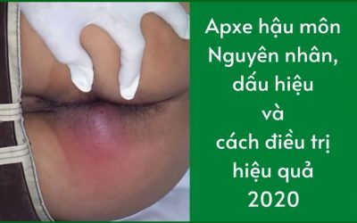Áp xe hậu môn: Nguyên nhân, dấu hiệu và cách điều trị hiệu quả
