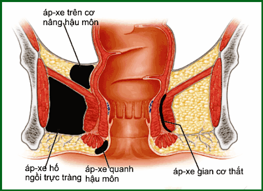 Bệnh áp xe hậu môn có nguy hiểm không?