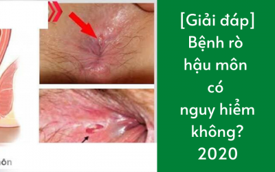 [Giải Đáp] Bệnh Rò Hậu Môn Có Nguy Hiểm Không?