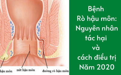 Bệnh rò hậu môn: Nguyên nhân, tác hại và cách điều trị