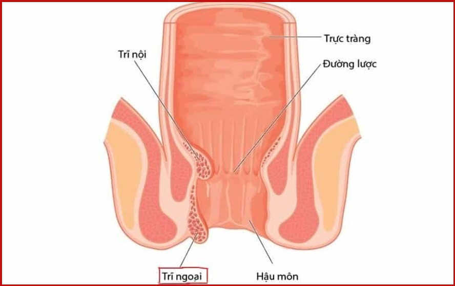 Bệnh trĩ nội nguyên nhân triệu chứng và cách chữa bệnh triệt để