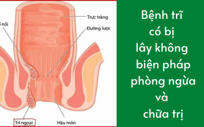 Bệnh trĩ có bị lây không biện pháp phòng ngừa và chữa trị hiệu quả