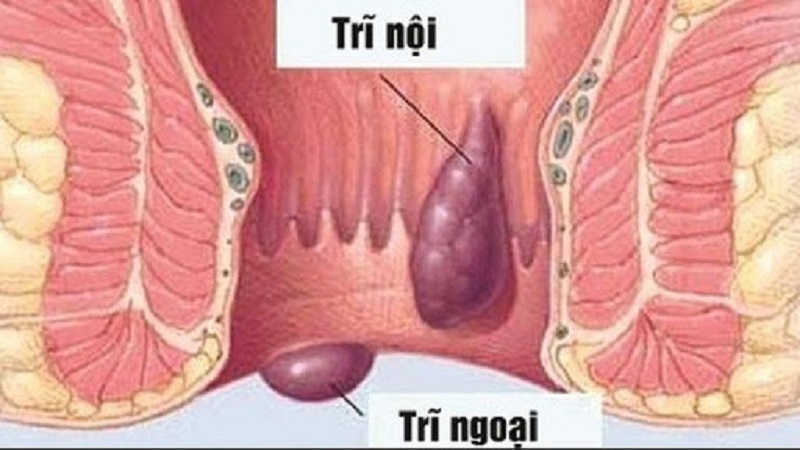 Bệnh trĩ có nhất thiết phải phẫu thuật cắt bỏ?