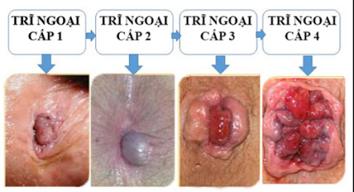 Cấp độ bệnh trĩ