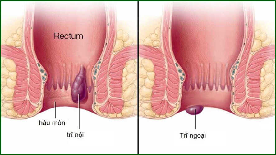 Các cấp độ của bệnh trĩ phát triển như thế nào?