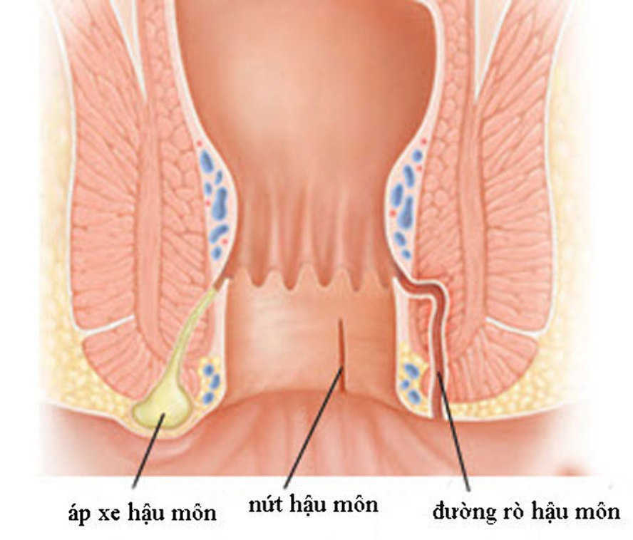 Hình ảnh bệnh nhân bị rò hậu môn