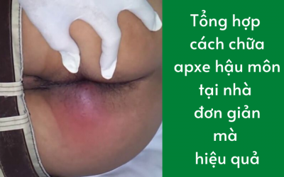 Tổng hợp cách chữa apxe hậu môn tại nhà đơn giản hiệu quả
