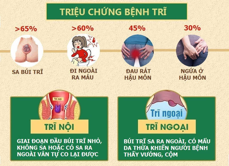 Triệu chứng của bệnh trĩ