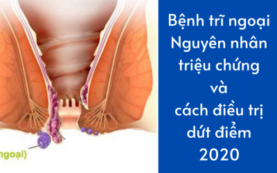 Bệnh trĩ ngoại: Nguyên nhân, triệu chứng và cách điều trị dứt điểm tận gốc