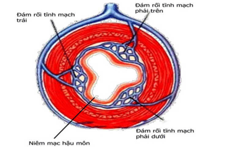 Khi nào cần phẫu thuật cắt trĩ vòng?