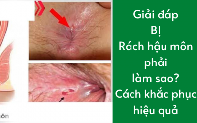 Giải đáp bị rách hậu môn phải làm sao? Cách khắc phục hiệu quả