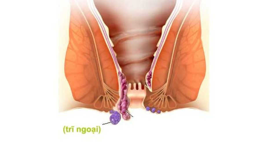 Tìm hiểu bệnh trĩ ngoại là gì?