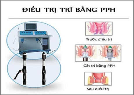 Máy pph dùng để cắt trĩ