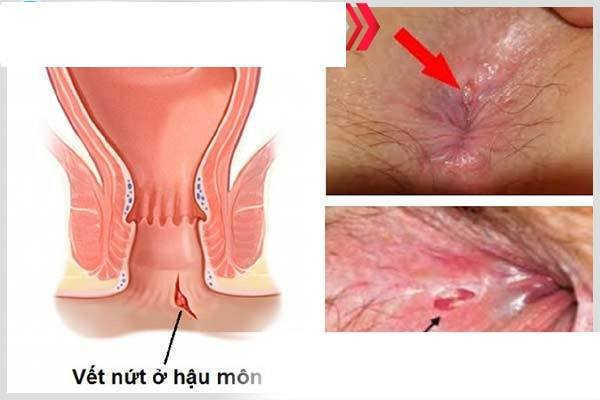 Nứt kẽ hậu môn hoặc viêm ống hậu môn