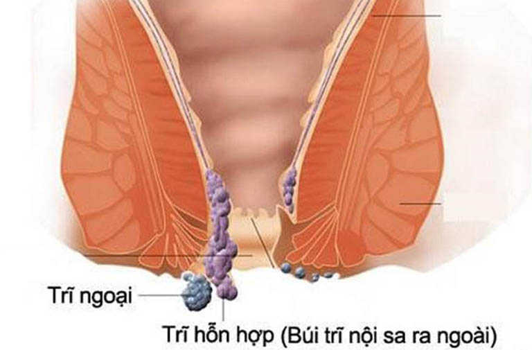 Bệnh trĩ hỗn hợp có nguy hiểm không? Triệu chứng và cách chữa trị