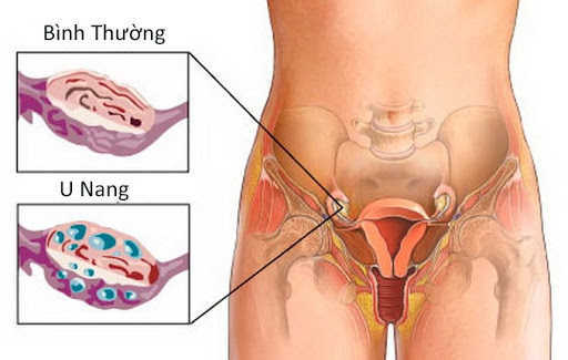 Chẩn đoán u nang buồng trứng