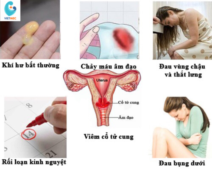 Hội chứng đau âm hộ mãn tính