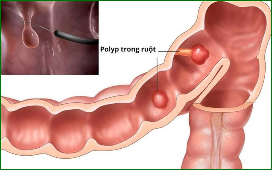 Táo bón đi cầu ra máu - triệu chứng polyp hậu môn