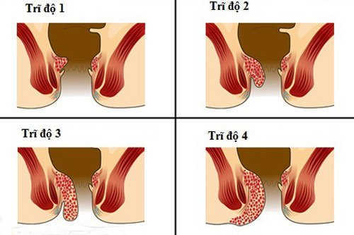 Bệnh trĩ nội độ 4 là gì?