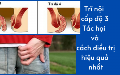 Trĩ nội cấp độ 3: Tác hại và cách điều trị hiệu quả nhất