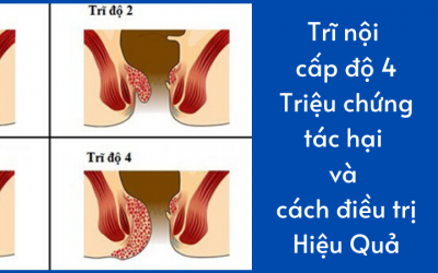 Trĩ nội cấp độ 4: Triệu chứng, tác hại và cách điều trị