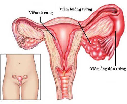 Viêm buồng trứng