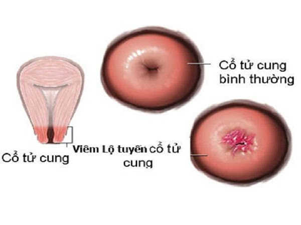 Bệnh viêm lộ tuyến cổ tử cung