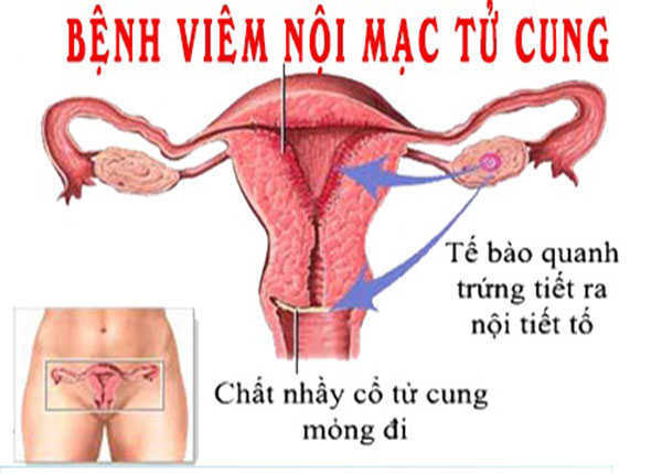 Viêm nội mạc tử cung