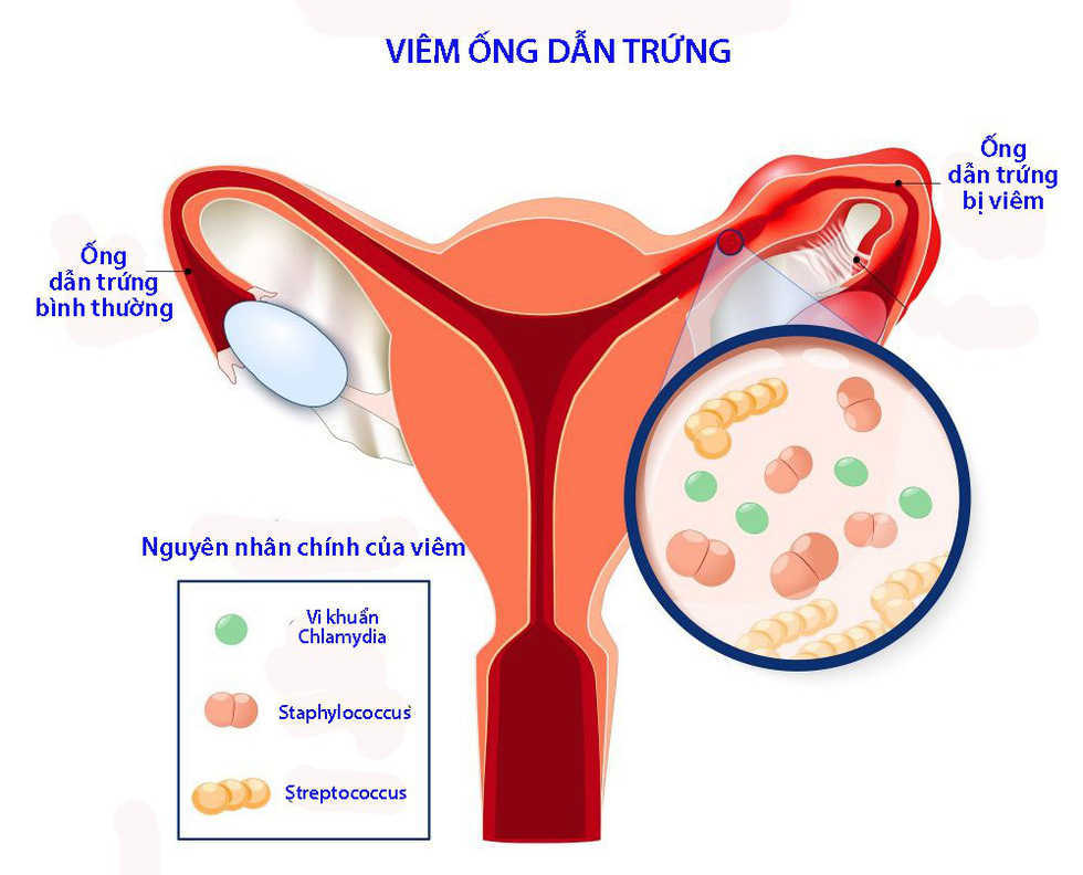 Viêm ống dẫn trứng