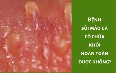 Bệnh sùi mào gà có chữa khỏi hoàn toàn được không?