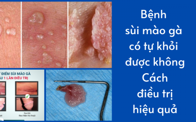 Bệnh sùi mào gà có tự khỏi được không: Cách điều trị hiệu quả