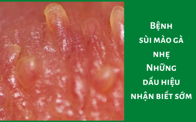 Bệnh sùi mào gà nhẹ: Những dấu hiệu nhận biết sớm