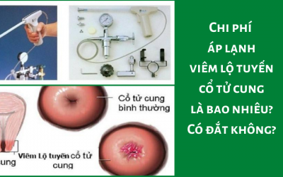 Chi phí áp lạnh viêm lộ tuyến cổ tử cung là bao nhiêu? Có đắt không?