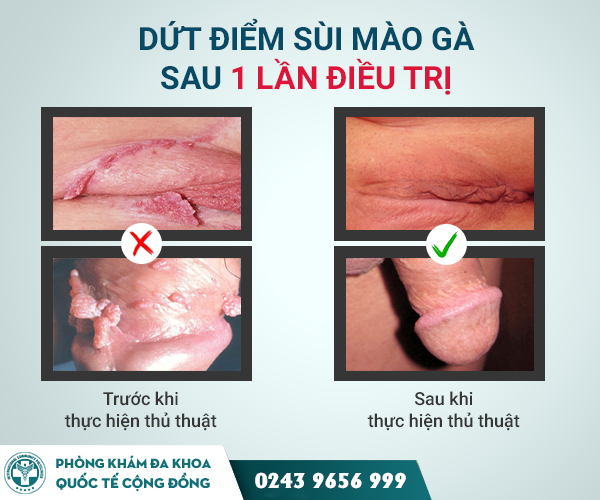 Điều trị sùi mào gà bằng kỹ thuật IRA