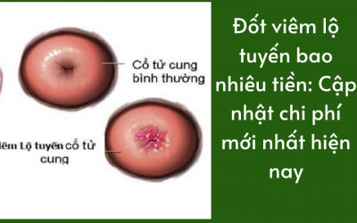 { Đốt Viêm Lộ Tuyến Bao Nhiêu Tiền } Chi Phí Điều Trị Nên Tham Khảo