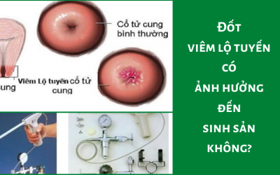 Đốt viêm lộ tuyến có ảnh hưởng đến sinh sản không?