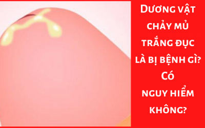 Dương vật chảy mủ trắng đục là bị bệnh gì? Có nguy hiểm không?