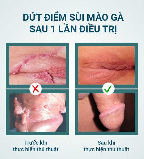 Chữa dứt điểm sùi mào gà trong 1 lần điều trị