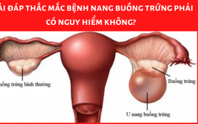 Giải đáp thắc mắc bệnh nang buồng trứng phải có nguy hiểm không
