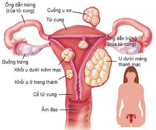 Bệnh u xơ tử cung và phương pháp mổ u xơ tử cung điều trị bệnh