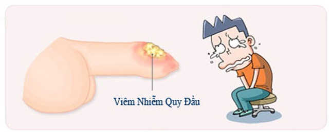 Viêm bao quy đầu là gì?