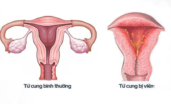 Niêm mạc tử cung bị tổn thương