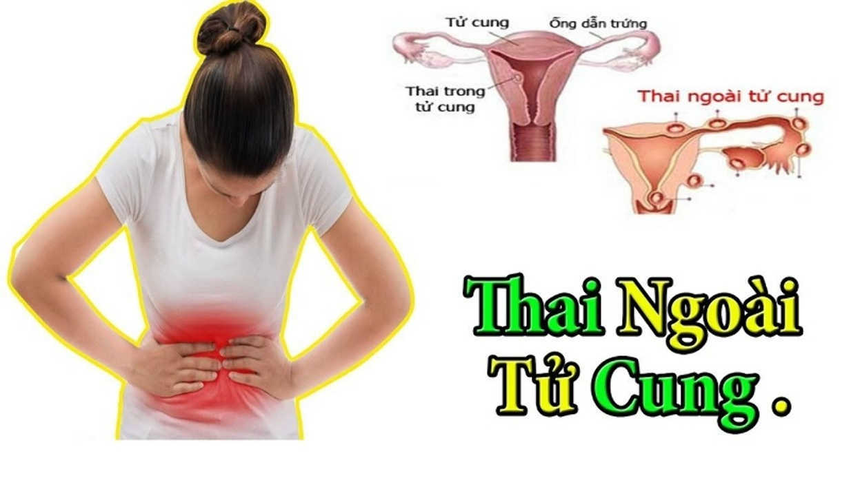 Khả năng mang thai ngoài tử cung cao