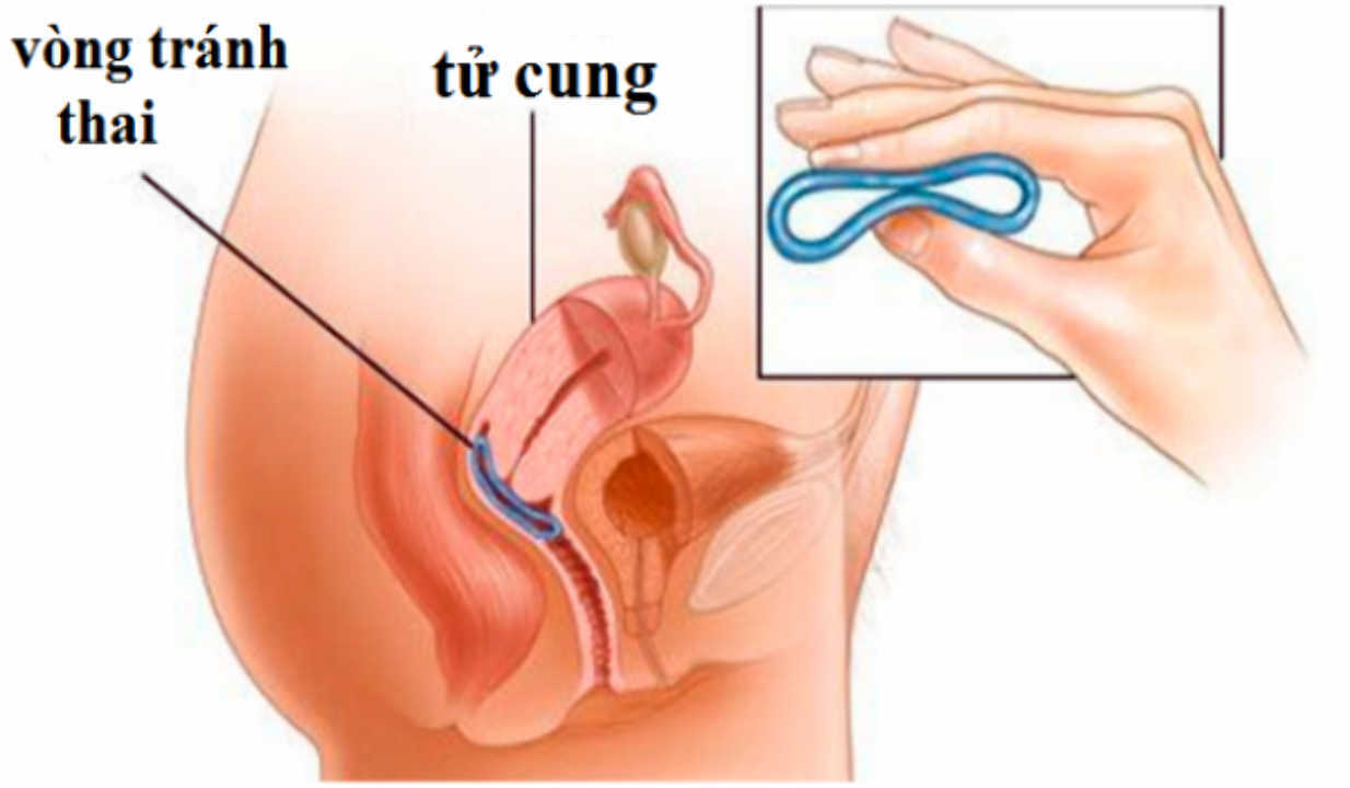 bác sĩ sẽ ấn piston để đẩy vòng tránh thai vào trong hốc tử cung