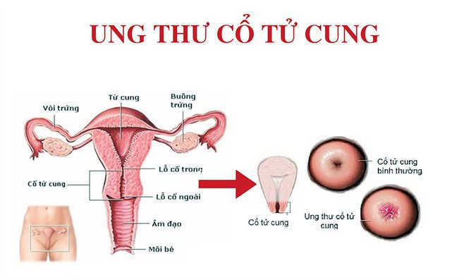 Đánh giá mức độ nguy hiểm của ung thư cổ tử cung