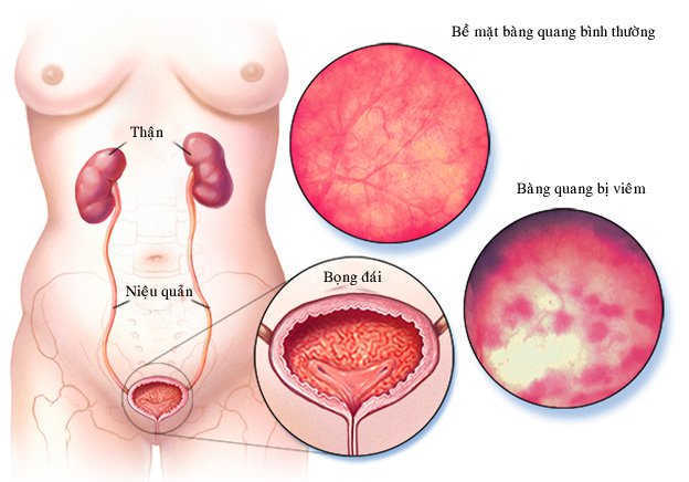 Viêm bàng quang do nhiễm vi khuẩn