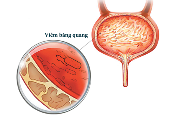 Viêm bàng quang mãn tính